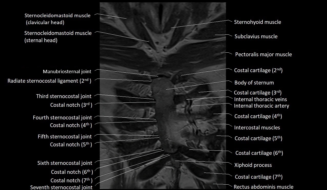MRI sternum and sternoclavicular joint labeled coronal anatomy image 8.webp